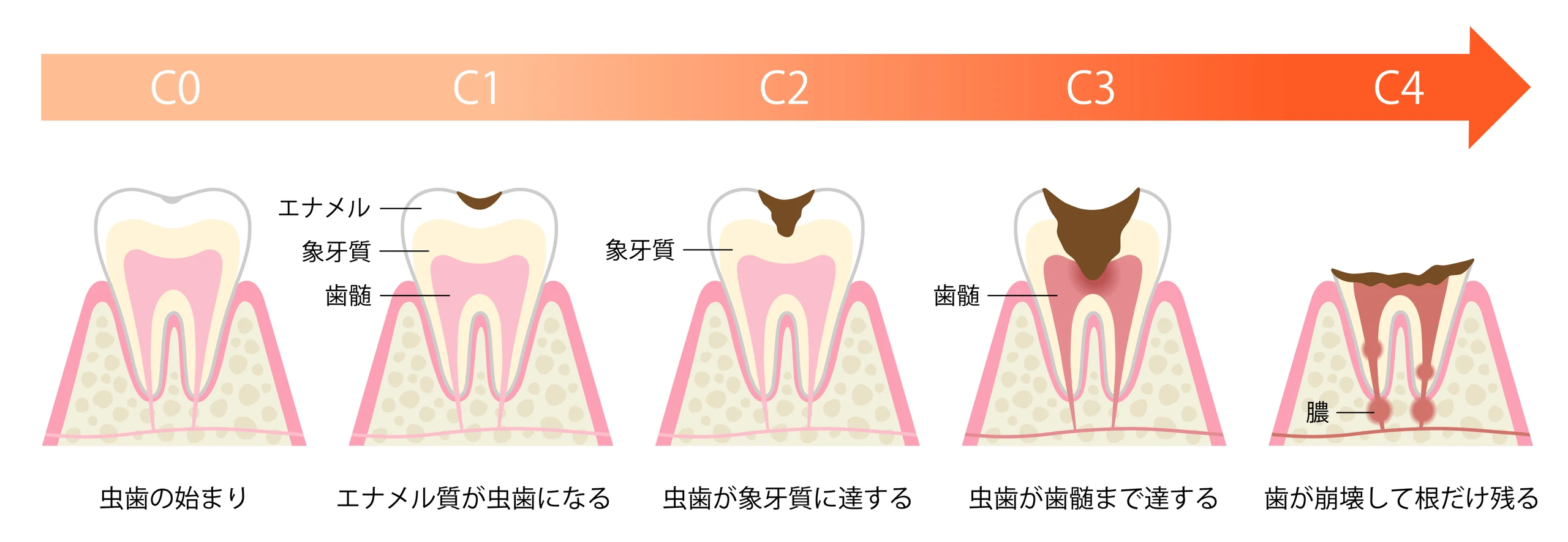 虫歯の進行度 C0からC4までの段階を示した図