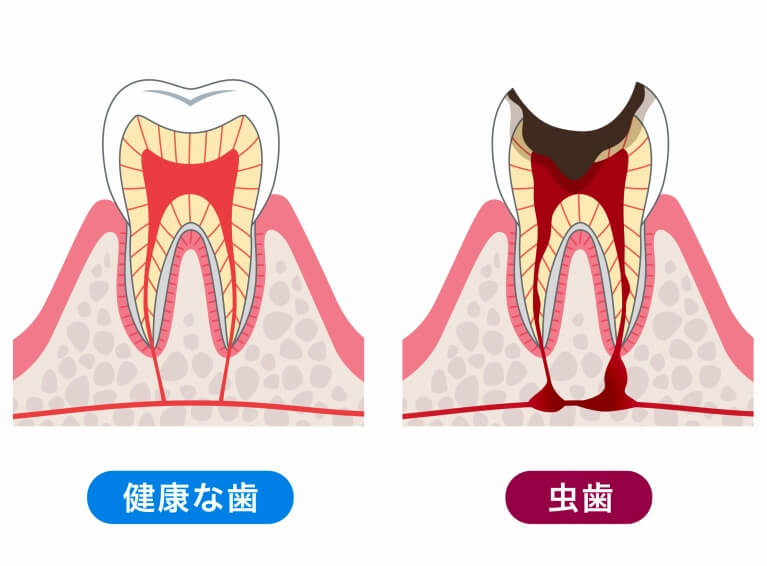 むし歯になる原因