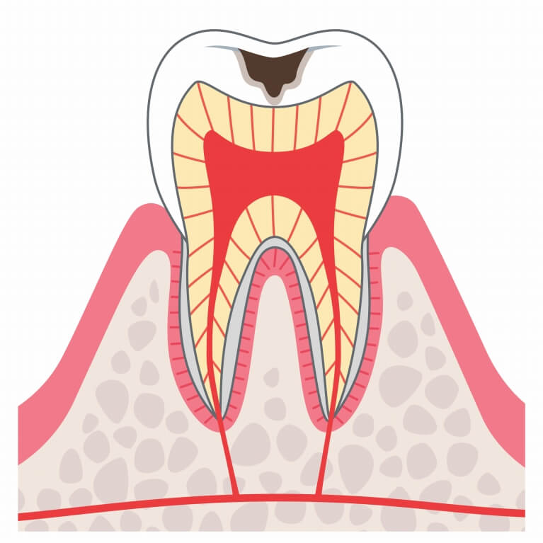 C２　歯の内側まで進んだむし歯