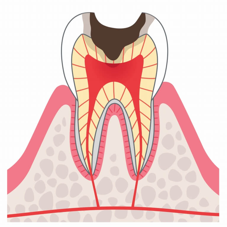 C３　神経まで進んだむし歯