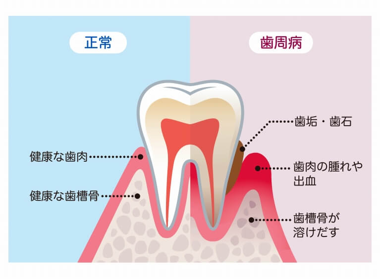 歯周病の治療について