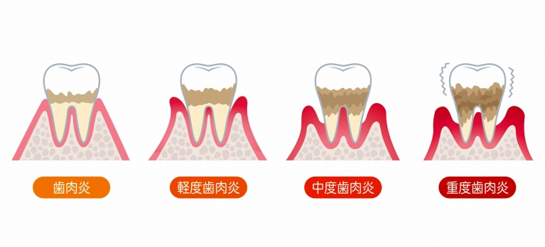 歯周病の進行について