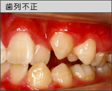 乱れた歯並び