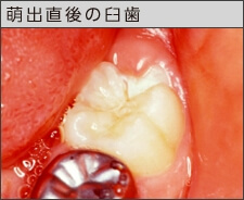 萌出したばかりの臼歯